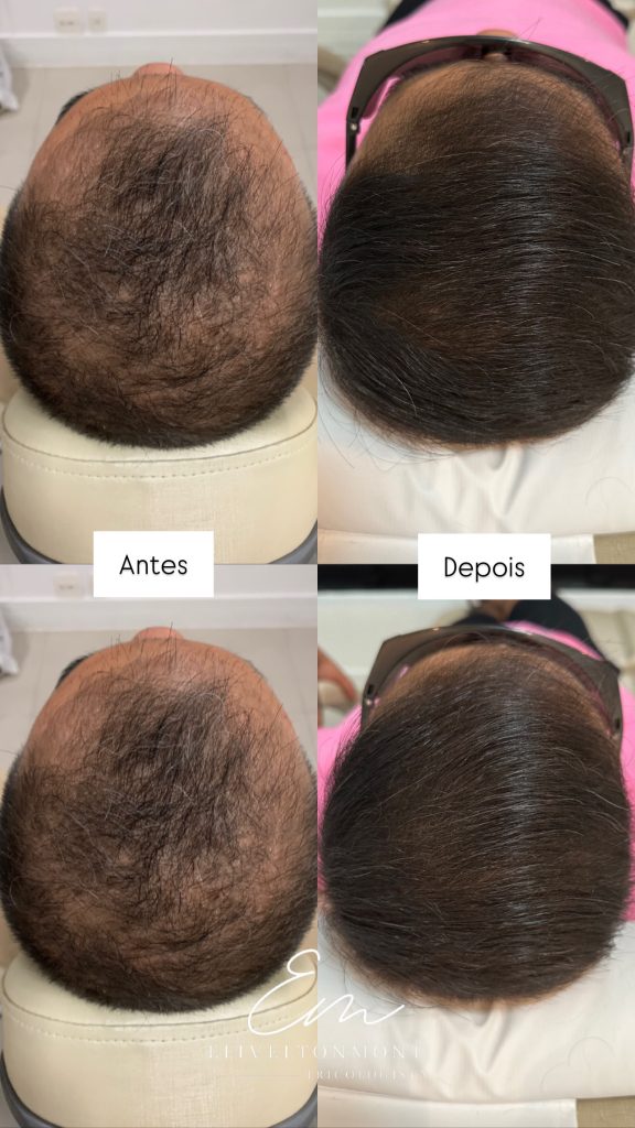 Antes e Depois - Tratamento capilar resultado 3 - Tricologista Moema SP
